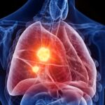 Marijuana Use May Raise Lung Cancer Risk, Researchers Warn